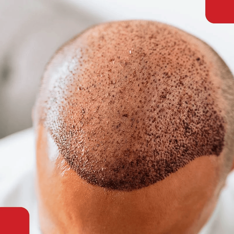 Basic Hair Transplant